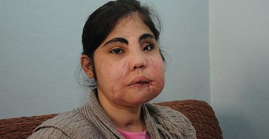 TÜRKİYE'NİN İLK YÜZ NAKLİ YAPILAN KADIN ÖLDÜ!